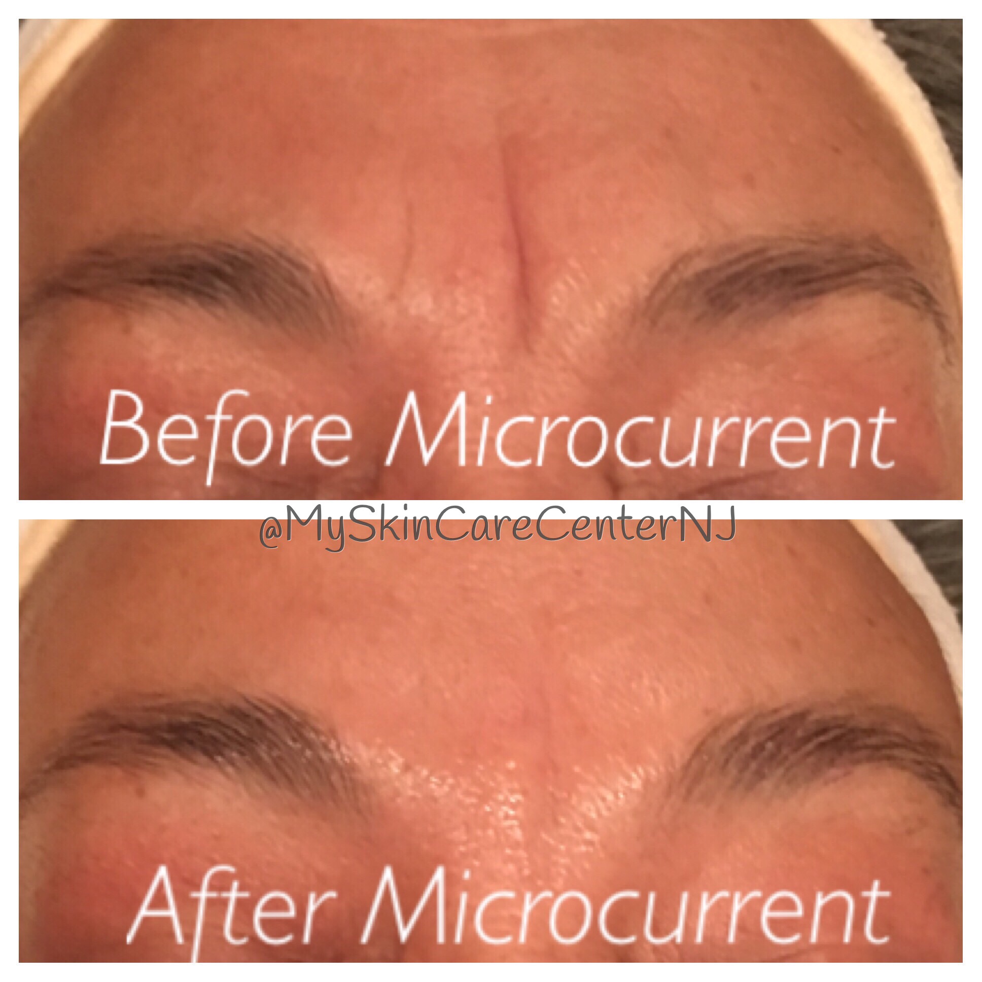after 1 Microcurrent Treatments