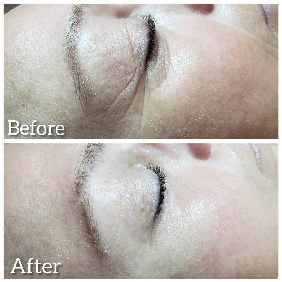 after 1 Microcurrent Treatments